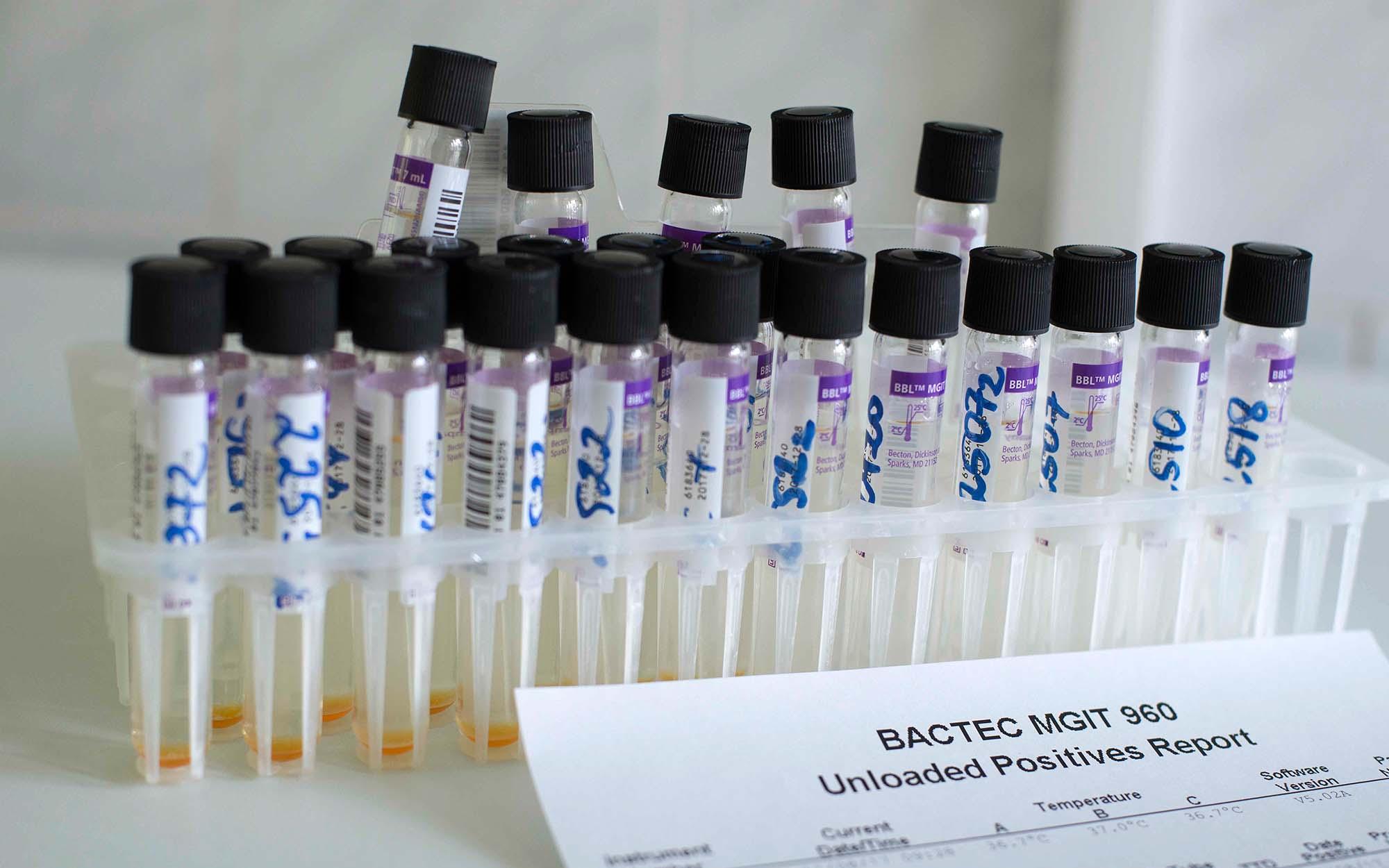 Samples from BACTEC test system used in TB diagnostics and follow-up.
