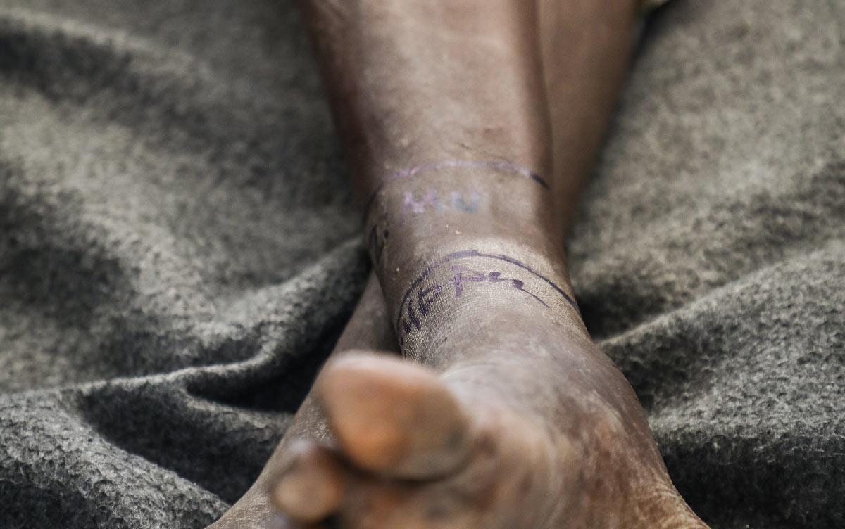 Bitten by a snake, the marks show the swelling at different times of the day.